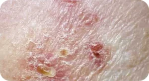 Sample dry skin